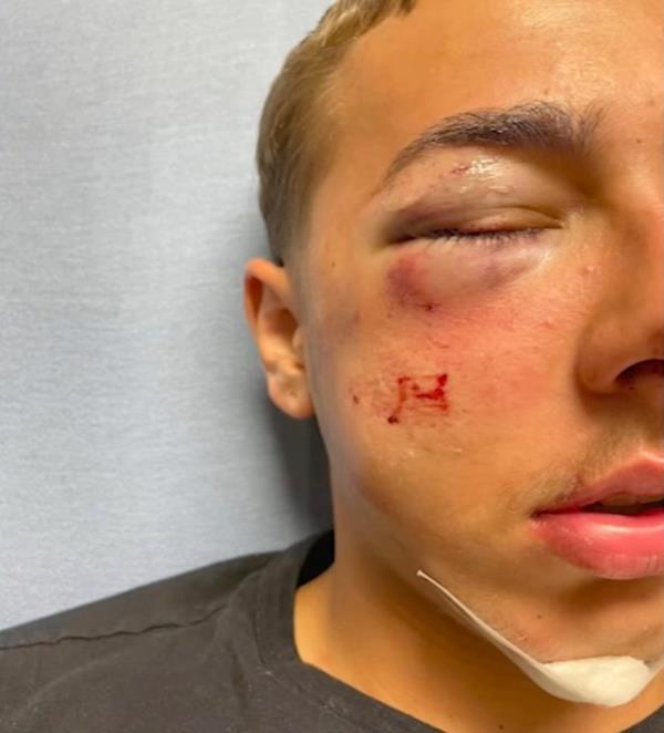 Relatives and a lawyer for Jayden, later revealed the teen suffered a fractured right orbital socket, along with a co<em></em>ncussion and bruises to his chest, shoulder, and the back of his neck, according to 6ABC.