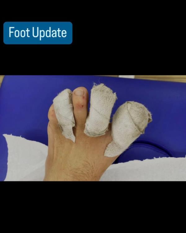 Colin Jost's injured foot