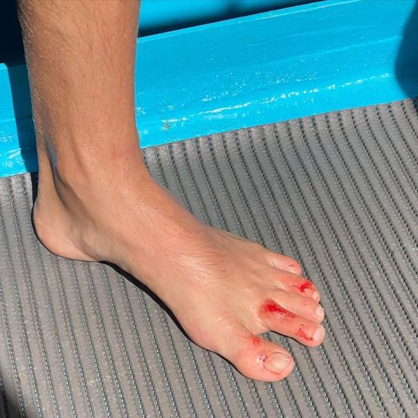Colin Jost cut his foot on the coral reef in Tahiti