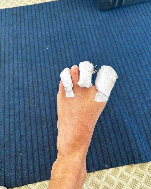 Colin Jost's bandaged foot